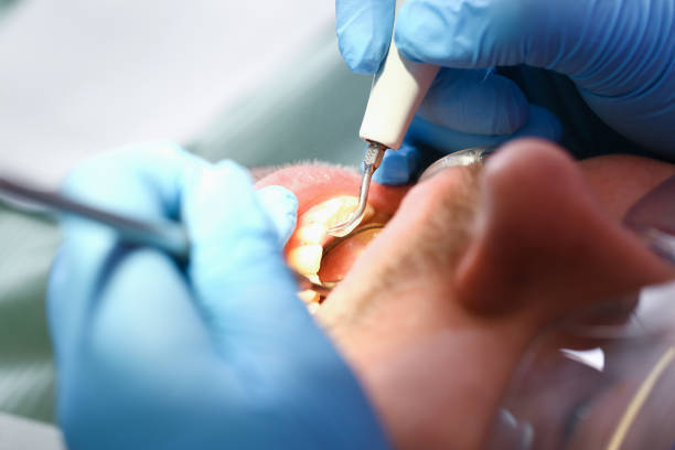 Best Emergency Treatment for Dental Infections or Abscesses in Mountain View, NC